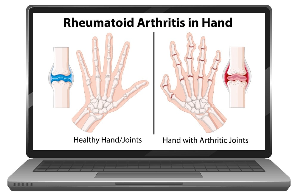 Rheumatoid arthritis in hand