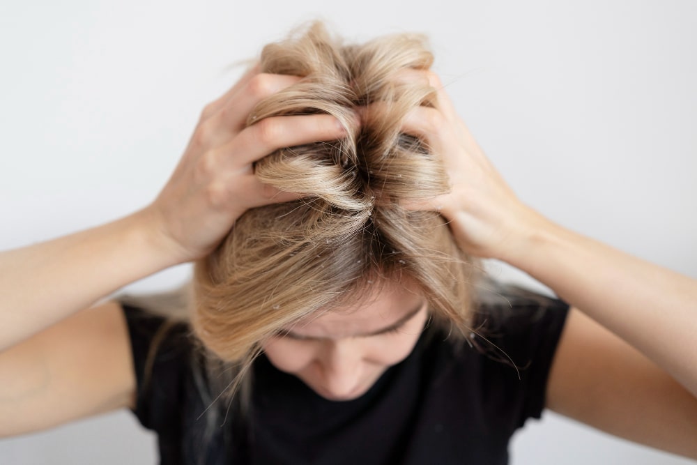 scalp yeast infection