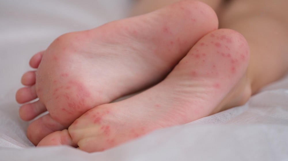 red spots on feets